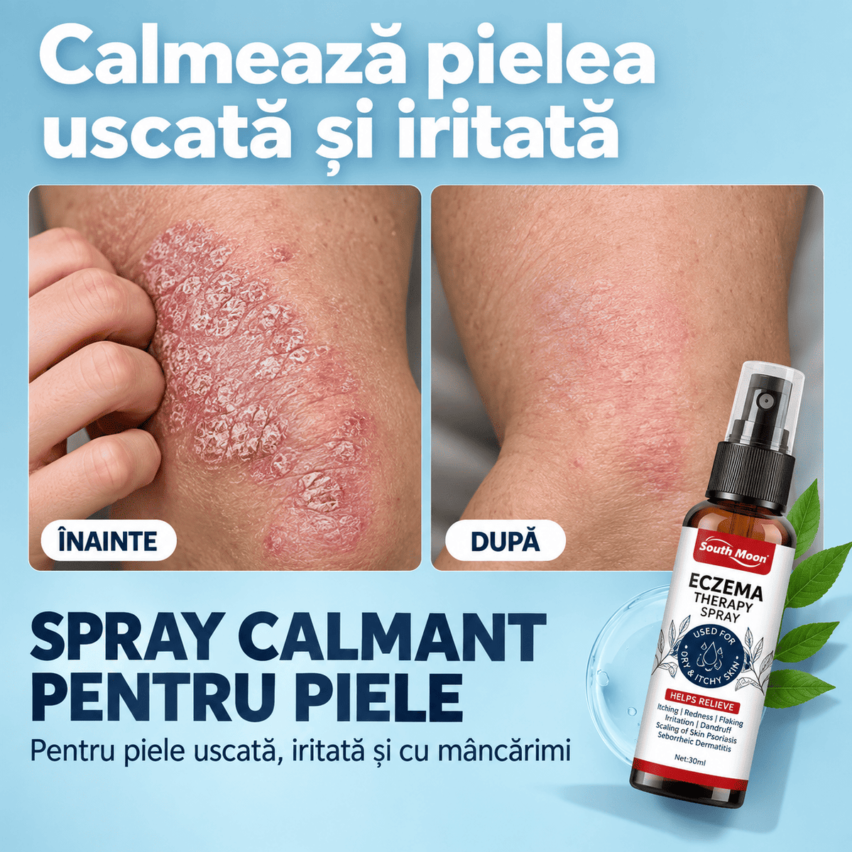 Spray Natural pentru Psoriazis și Mâncărime