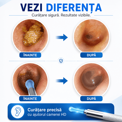 Dispozitiv pentru Curățarea Urechilor cu Cameră HD