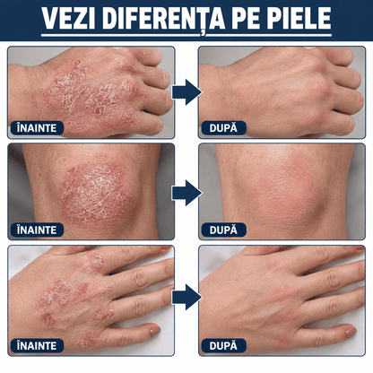 Spray Natural pentru Psoriazis și Mâncărime