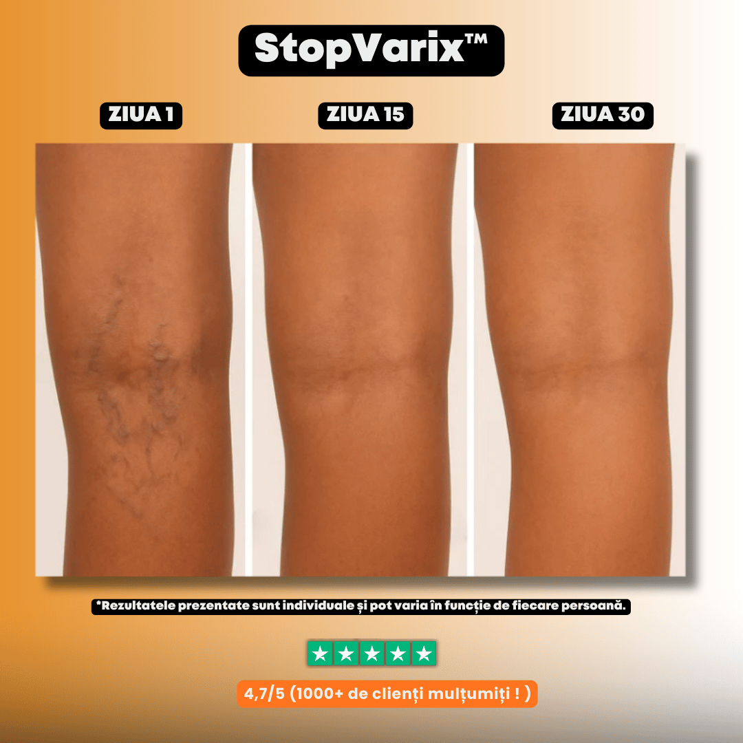 Plasturi naturali pentru varice și picioare obosite – StopVarix™